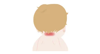 ウンナ母斑
