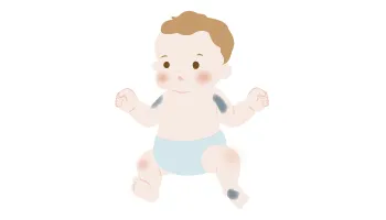 異所性蒙古斑