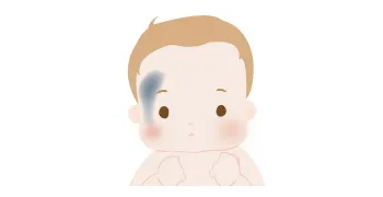 太田母斑
