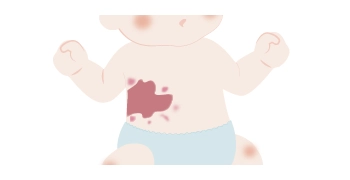 単純性血管腫